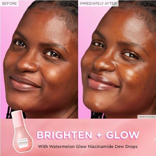 Before and after using Watermelon Glow Niacinamide Dew Drops showing skin enhancement.