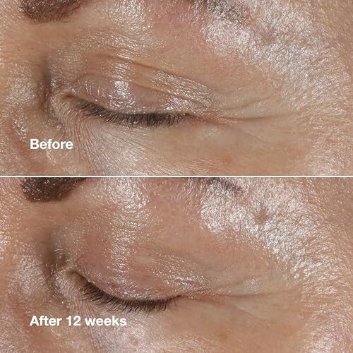 Comparison of eye skin before and after 12 weeks of treatment