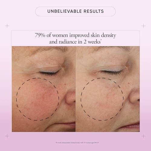 Before and after skin improvement showing enhanced skin density and radiance.