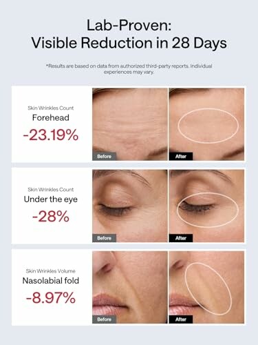 Before and after images showing skin wrinkle reduction on forehead, under the eye, and nasolabial fold with percentage improvements.